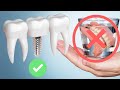 Dentures vs Dental Implants