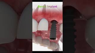 Dental Implant 3d Animation