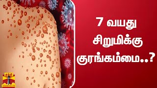 7 வயது சிறுமிக்கு குரங்கம்மை..?