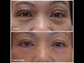 fibroblast under eyes