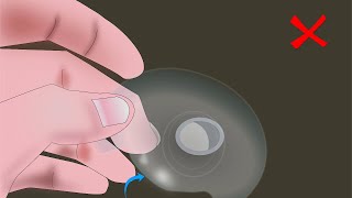 Complication of Using Nipple Shields- English