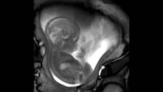 MRI scan at 21 weeks