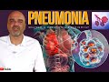 PNEUMONIA: o que é? Como é o começo da pneumonia? O que leva uma pessoa a ter pneumonia?