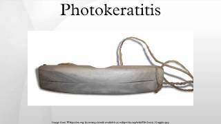 Photokeratitis