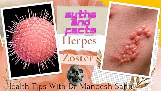 Herpes Zoster: Myths and facts