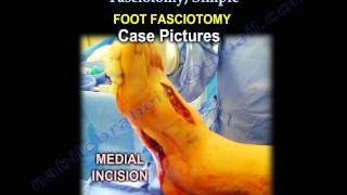 Compartment Syndrome \u0026 Fasciotomy, Simple - Everything You Need To Know - Dr. Nabil Ebraheim