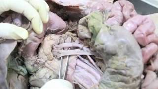 Anatomy Dissection of Pancreas \u0026 Duodenum