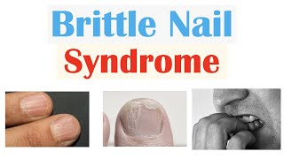 Brittle Nail Syndrome | Causes, Signs \u0026 Symptoms, Diagnosis, Treatment, Supplements