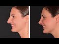 Rhinoplasty Before & After Compilation