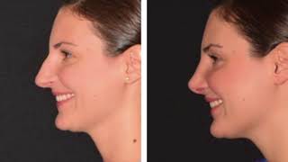 Rhinoplasty Before \u0026 After Compilation