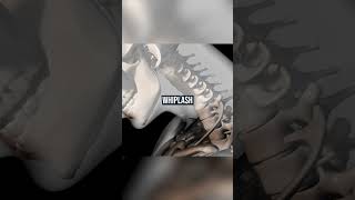 Whiplash in a Car Accident
