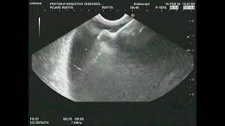 EUS Guided Cystogastrostomy.