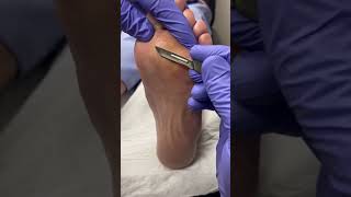 Watch Australian Podiatrist Expertly Remove Thick Forefoot Callus