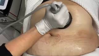 Esbelta Cavitation and Radiofrequency System - NON invasive Body Contouring