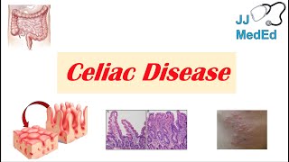 Celiac Disease (& Gluten Sensitivity): Risk Factors, Pathogenesis, Symptoms, Diagnosis, Treatment