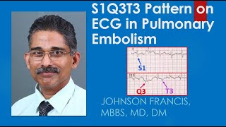 S1Q3T3 Pattern on ECG in Pulmonary Embolism