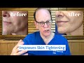 Should You Get Microneedling or Laser Resurfacing  Plastic Surgeon's Advice