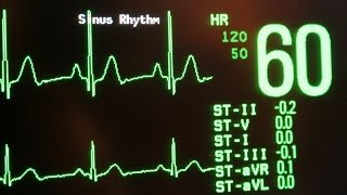 Normal sinus rhythm