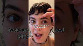 Can T Believe This Pimple Patch Peel Pimplepatch Pimplesolution