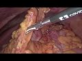 Laparoscopic colonic pull-through and delayed coloanal anastomosis for colonic necrosis