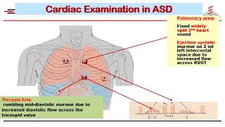 Acyanotic Congenital heart disease  part 2