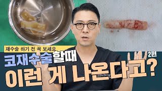 152화  코재수술할때 이런것들이 나와요 2편 (feat. 자가늑연골, L자실리콘, etc)