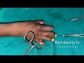 Syndactyly Release of Fingers Webbing