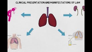 Lymphangioleiomyomatosis -- BAVLS