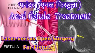 Story of a patient with Anal fistula I Laser versus Open fistula surgery