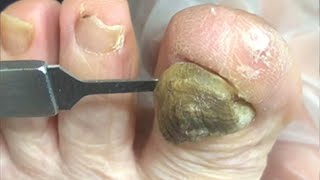 Onychomycosis trimming treatment: instant removal【Foot Scalpel】