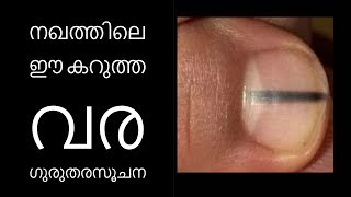 നഖത്തിലെ ഈ കറുത്ത വര ഗുരുതരസൂചന||Health Tips Malayalam