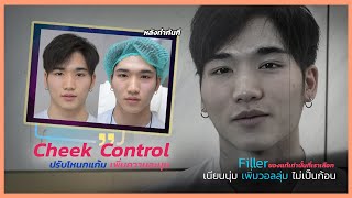 ลดโหนก แก้โหนกแก้มไม่เท่ากัน ไม่ต้องทุบโหนก ด้วย FILLER ฉีดยังไงให้หน้ามีมิติ ดูดี ไม่มีผลข้างเคียง