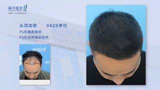 FUE點陣加密真的會有效果嗎？大陸髪友植髮術後效果曝光！Yonghe hair transplant