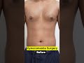 Gynecomastia treatment in delhi | Gynecomastia Surgery cost