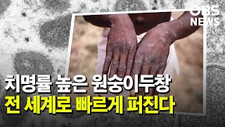 전 세계로 퍼지는 원숭이두창.. 15개국 확산