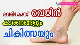 Causes and treatment of varicose veins | വെരികോസ് വെയിൻ കാരണങ്ങളും ചികിത്സയും| Ethnic Health Court