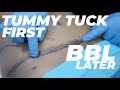 Why Dr. William Recommends a Tummy Tuck Before a BBL