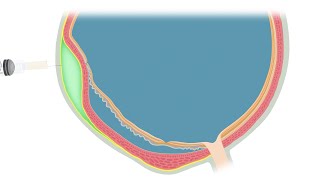 Animated Illustration of the Suprachoroidal Viscopexy Procedure