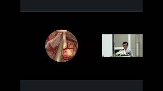 Endoscopic Microvascular Decompression for Trigeminal Neuralgia – Dong Van He