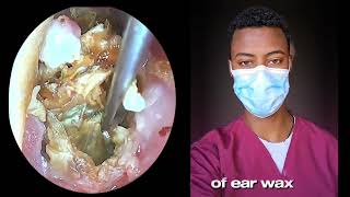 🔴Huge Ear Wax Removal - Watch the Magic out  Happen!”#2025#ear#new#earcleaning