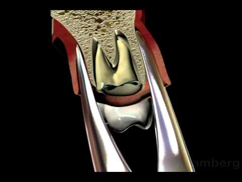 How do dentist pull teeth that are broken off?