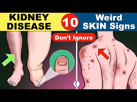 Does kidney failure make your face swell?