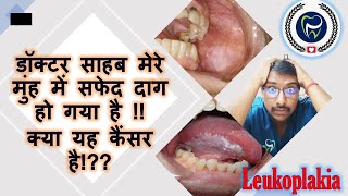 Dr Rudra Mohan |डॉक्टर साहब मेरे मुंह में सफेद दाग हो गया है !!क्या यह कैंसर है!??| Leukoplakia