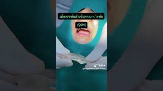 เผือกสบฟันสำหรับคนนอนกัดฟัน#Splint #softandsmiledentalclinic