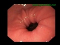 youtube peristaltic wave in the gastric antrum