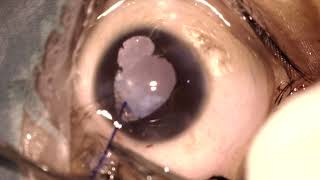 Pediatric Cataract with Iris Coloboma and Microcornea