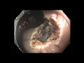 Colonoscopy: Distal Ascending Colon EMR - Position Change Helps