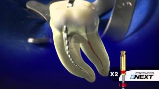 PROTAPER NEXT® Clinical with Dr. Ruddle | Dentsply Sirona