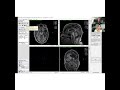 lesion segmentation with itk snap