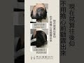 4019根 前額加密植髮 植髮 植髮手術 前額植髮 台灣植髮 fue hairtransplant 秀冠植髮 林俊志醫師